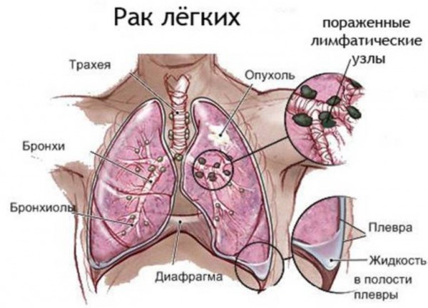 рак легких